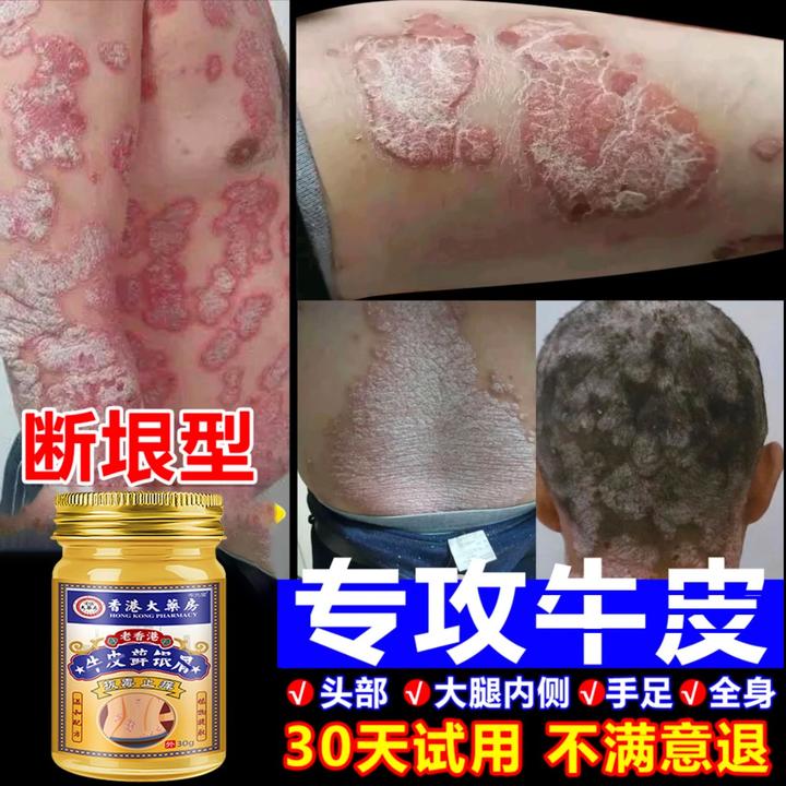 【一款很牛的膏】全身皮肤清凉止痒通用草本萃取断痒王外用涂抹乳膏