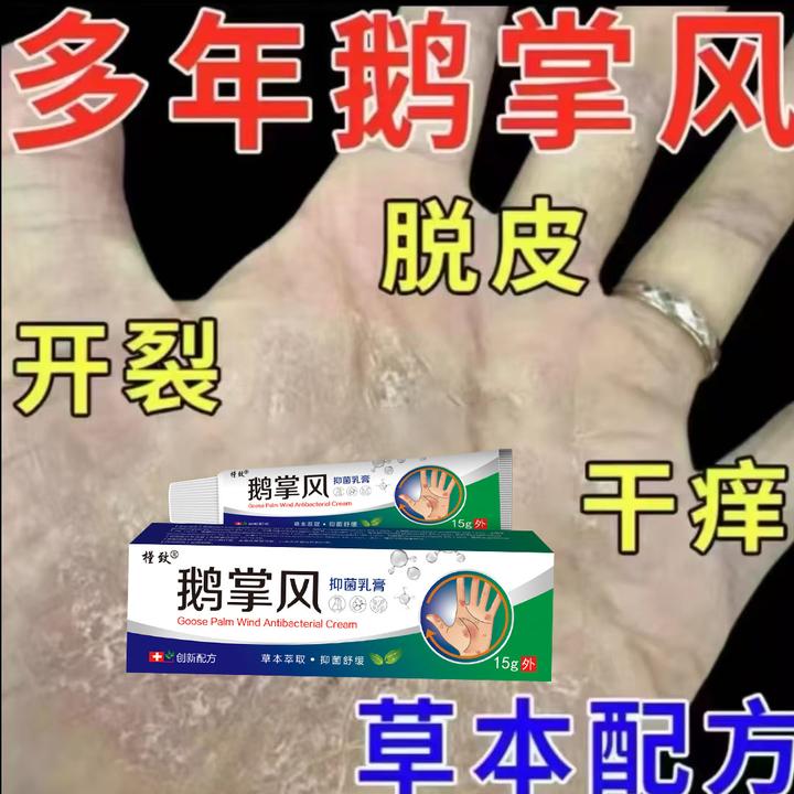 手足脱皮膏鹅掌风干裂脱皮手痒手裂口手足霜手足软膏脚干抑菌软膏
