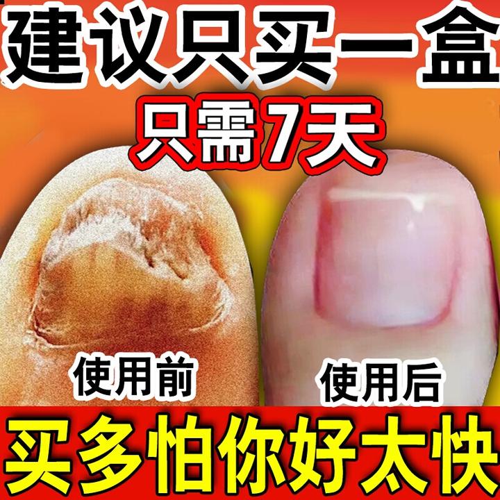 灰指趾甲灰脚指甲专用抑菌液特亮甲坏甲效趾甲复抑菌液