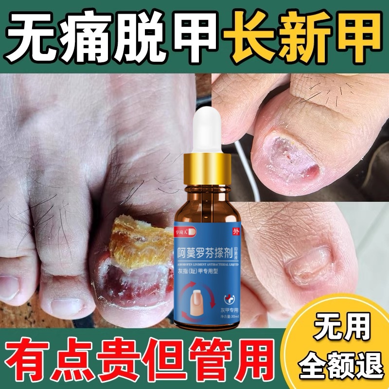 阿莫罗芬灰趾指甲药水凤仙花去坏软甲亮甲抑菌液修护脚指甲专用