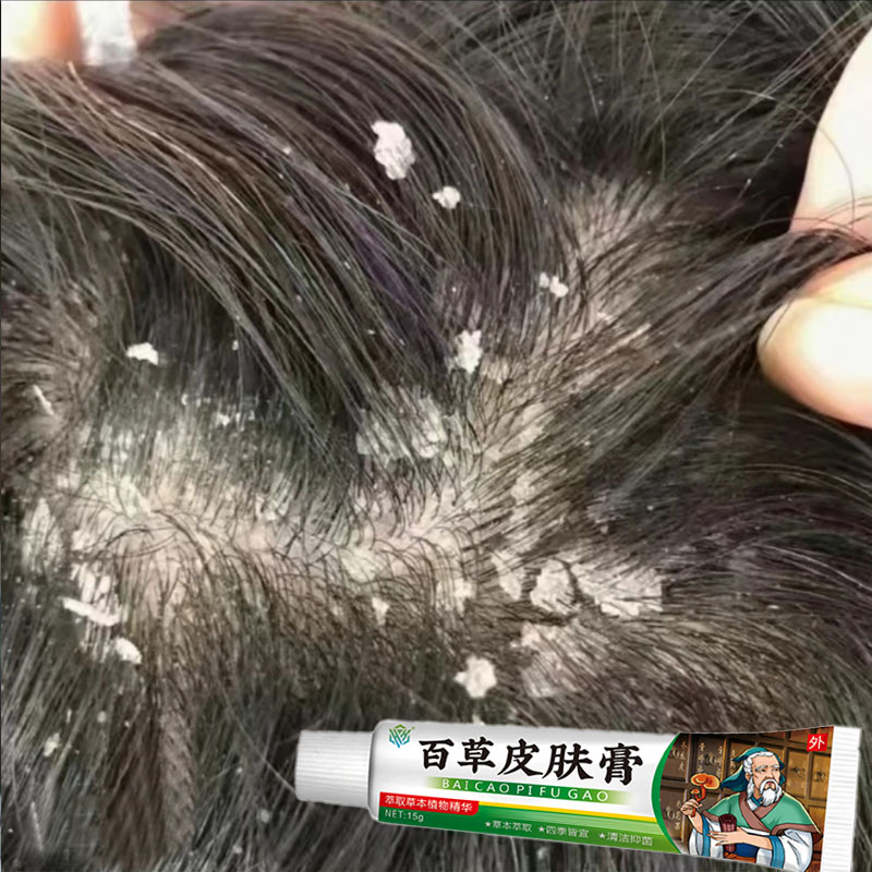 头皮屑多大块白色头部结痂乳膏头皮止痒抑菌专用毛囊红疙哒修复