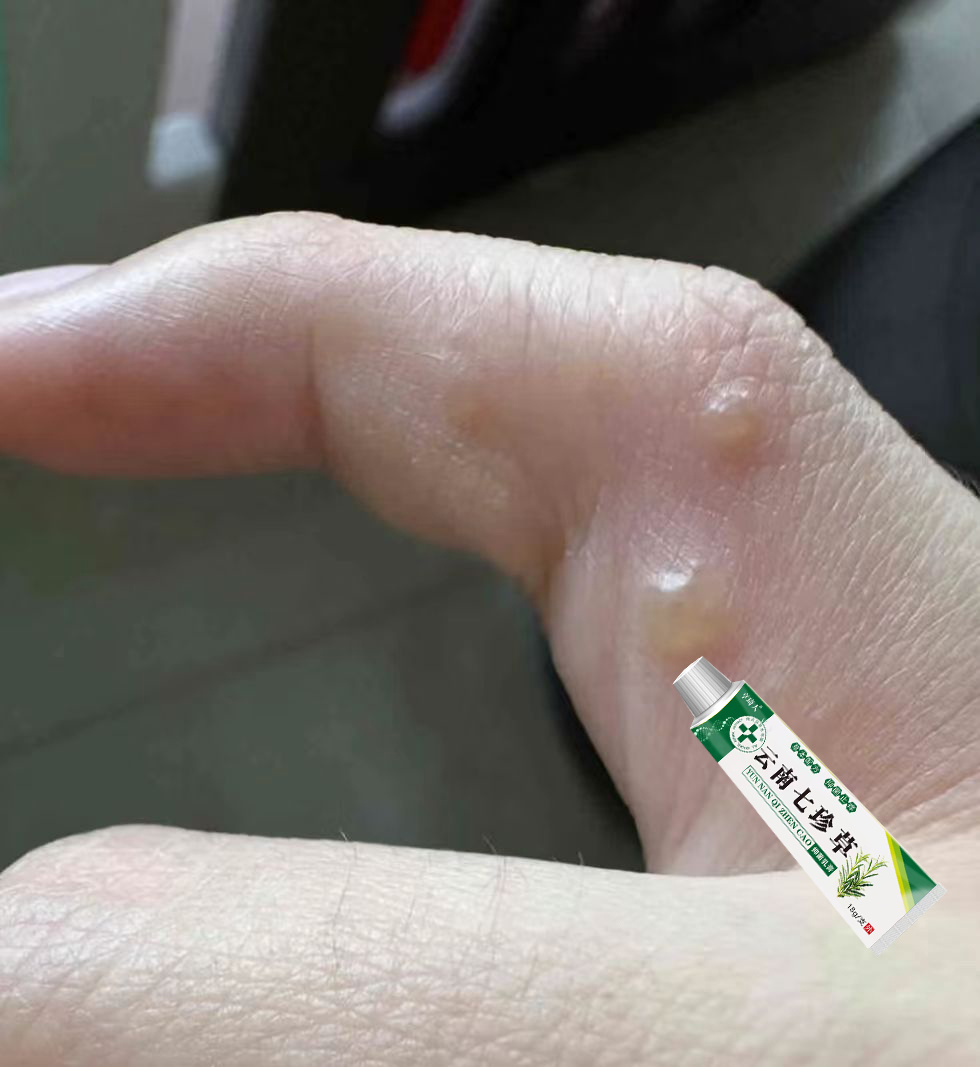 手上有小水·泡汗状水·泡痒手足脱皮手足起小水泡止痒抑菌乳膏