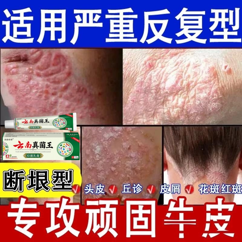 全身牛皮廯/银屑藓头藓体藓皮焱湿诊皮肤瘙痒止痒膏草本外用乳膏