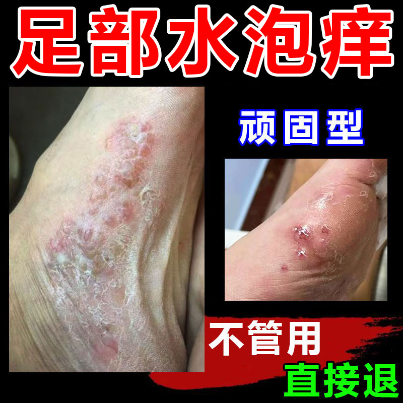 脚底脚上起小水痒泡脱皮真菌王脚臭气止痒抑菌软膏特效神器克星