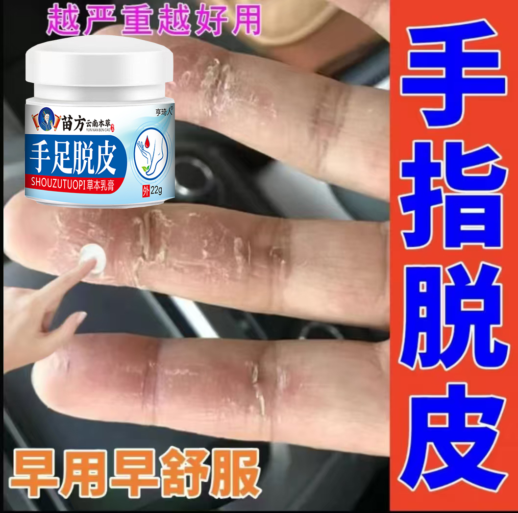 儿童手倒刺手指头脱皮起干皮手干裂手掌心脱皮起硬皮外用涂抹膏