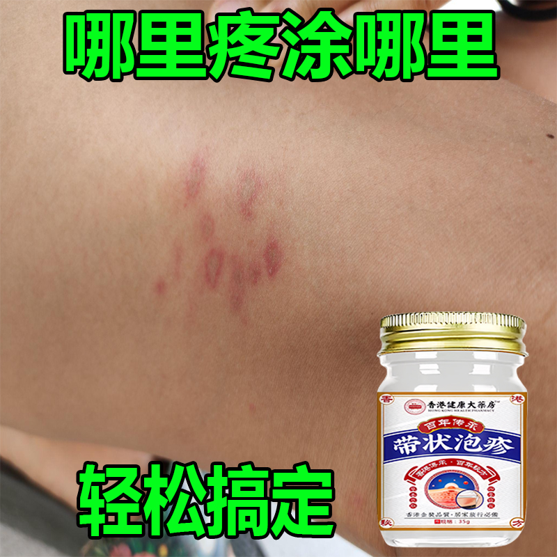 带状泡疹后遗神经痛蛇盘疮膏蛇盘清宝带状疱疹后遗症神经痛特效药