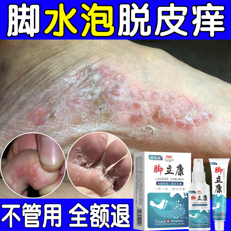 脚底脚上起小水痒泡又脱皮真菌王脚臭止痒抑菌软膏特效神器克星