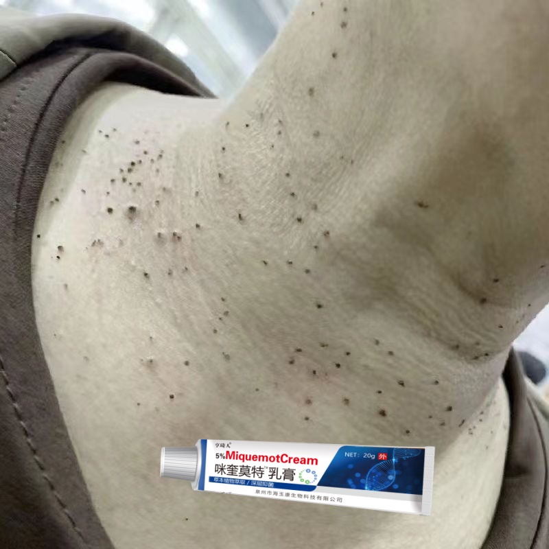 【小肉粒一点无忧】正品咪奎莫克5%脖子丝状扁平寻常肉刺手足腋下