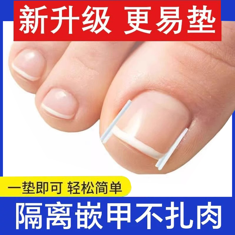 甲沟炎矫正神器指甲矫正器嵌甲专用脚趾甲长肉里正甲隔离填充垫片