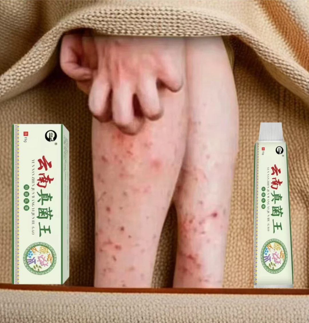 腿上干燥起皮小腿皮肤痒止痒抑菌膏秋冬小腿起疙瘩痒的抓出血止痒