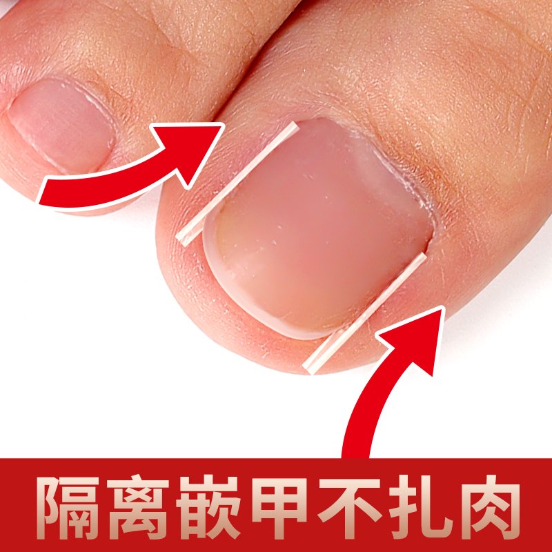 甲沟矫正器嵌甲脚趾脚指甲纠正正甲贴贴片趾甲神器专用填充垫