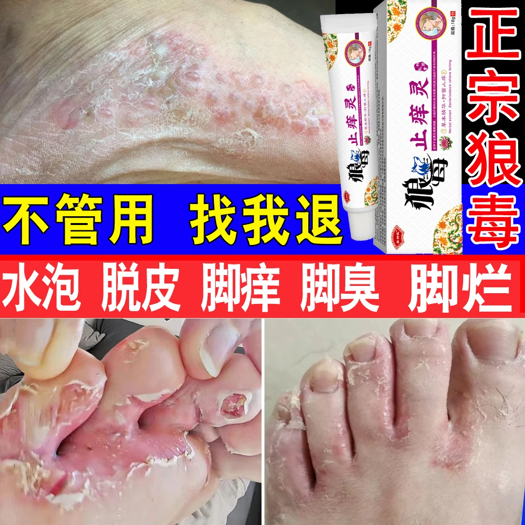 狼毒脚臭气脚趾缝痒脚丫脱皮脚汗喷雾剂止痒灵特效王克星水泡神器