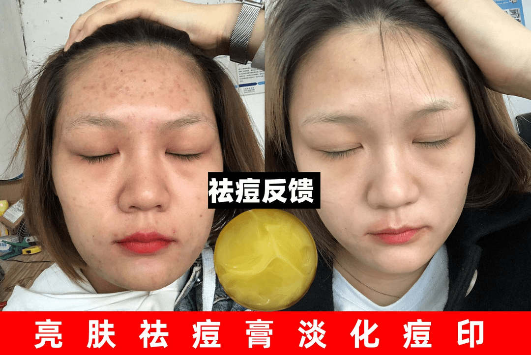 2主播自用在家使用祛痘组合男女通用肌肤保健膏