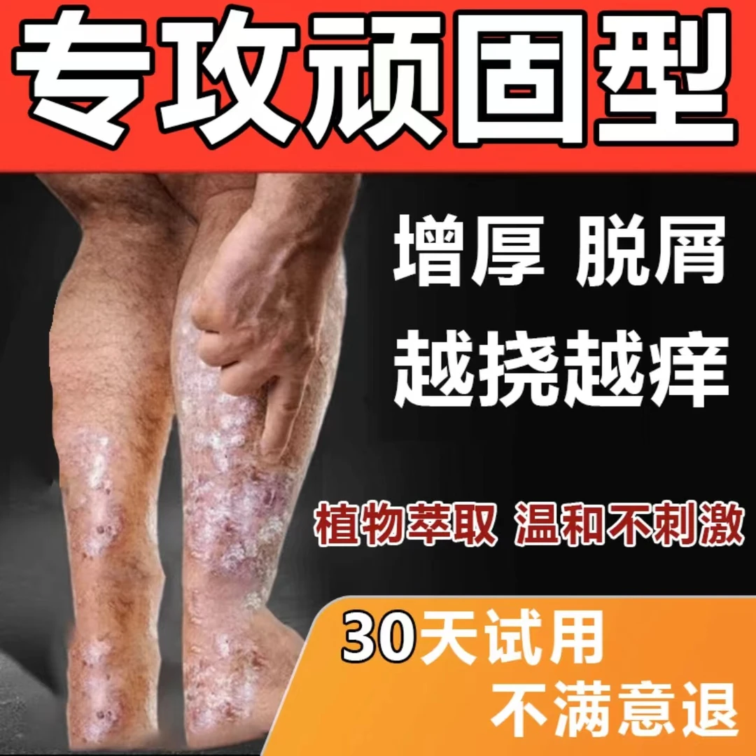 牛皮专用膏顽廯王银屑止痒膏全身红斑疙瘩皮肤瘙痒外用草本止痒膏