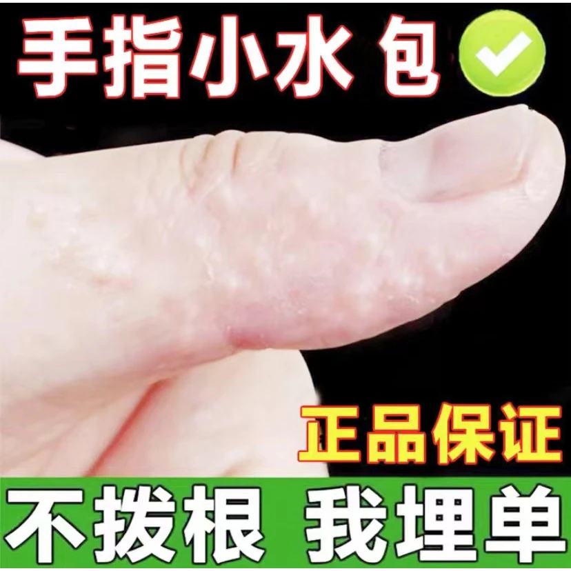 汗炮痒手上小水炮快速止痒手足痒草本萃取温和清凉止痒膏