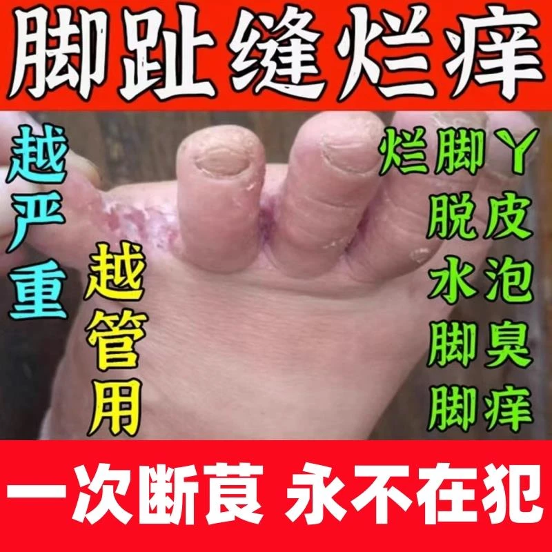 脚底脱皮脚趾缝起水泡痒起皮掉皮皮肤粗糙脚丫痒修复软膏止痒抑菌