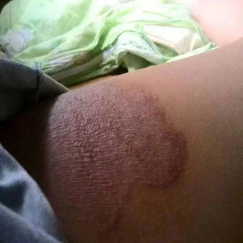 大腿内侧痒大腿两侧皮肤干皮发黑止痒抑菌湿毒膏