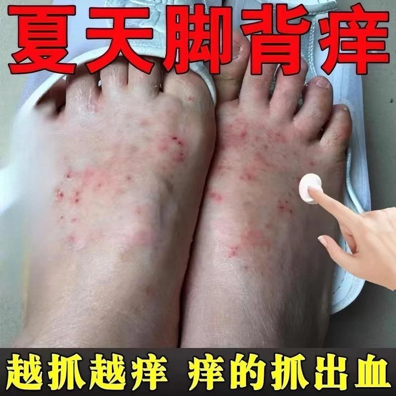 脚背痒脚面痒脚面干燥发痒止痒膏脚面红斑抓烂流水脚面抑菌软膏