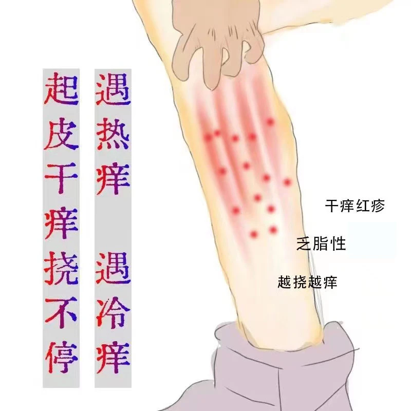 腿上干燥起皮小腿干痒冬天皮肤痒褪皮腿部起红点疙瘩止痒抑菌膏