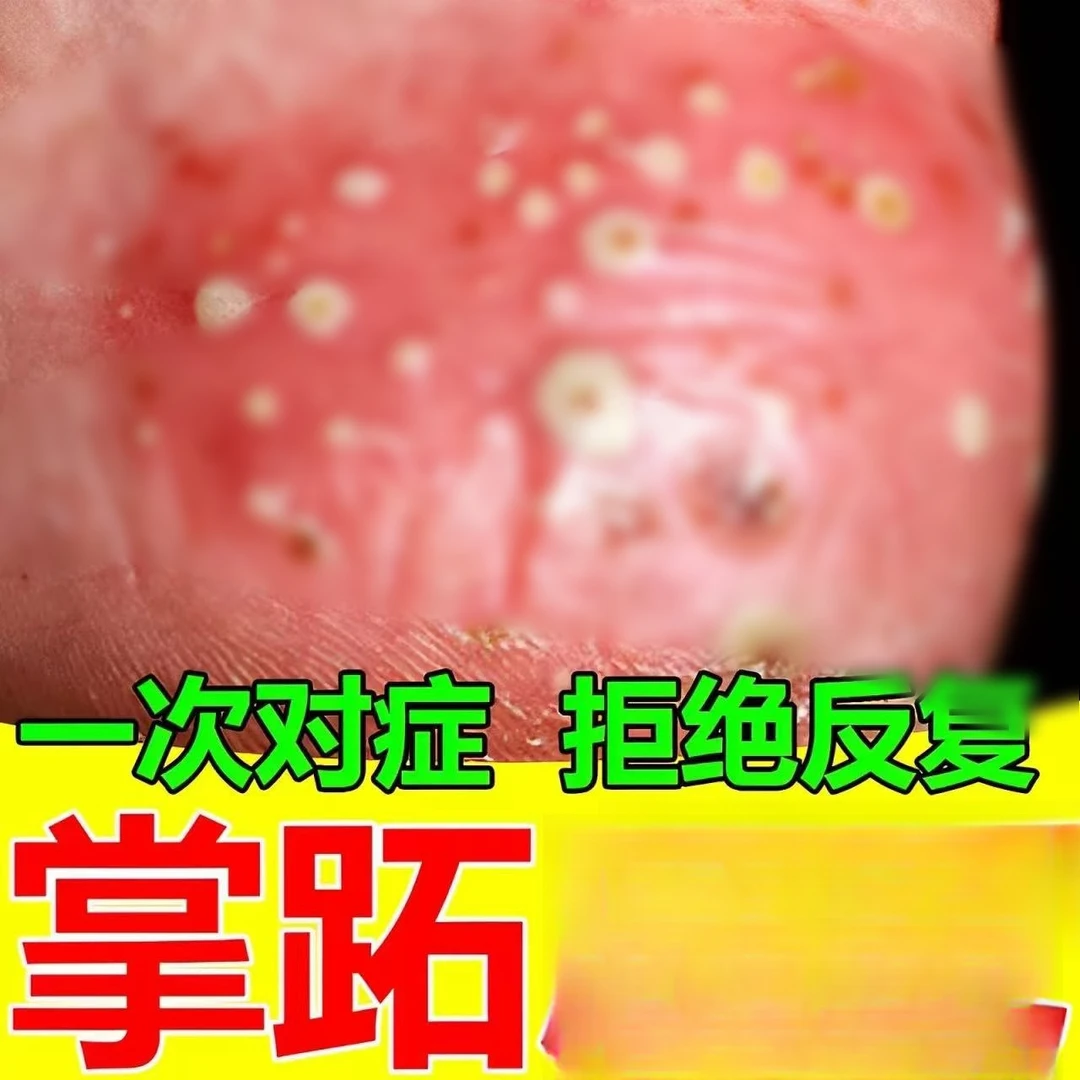 掌跖脓包病膏掌趾脓包手足脓包病脚脓泡脱皮干裂掌跖角化症 睡袋