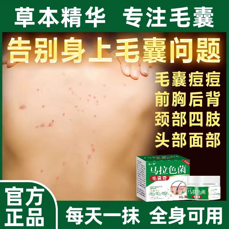 马拉色菌毛囊膏前胸后背红肿痘痘红点疙瘩温和草本抑菌涂抹外用