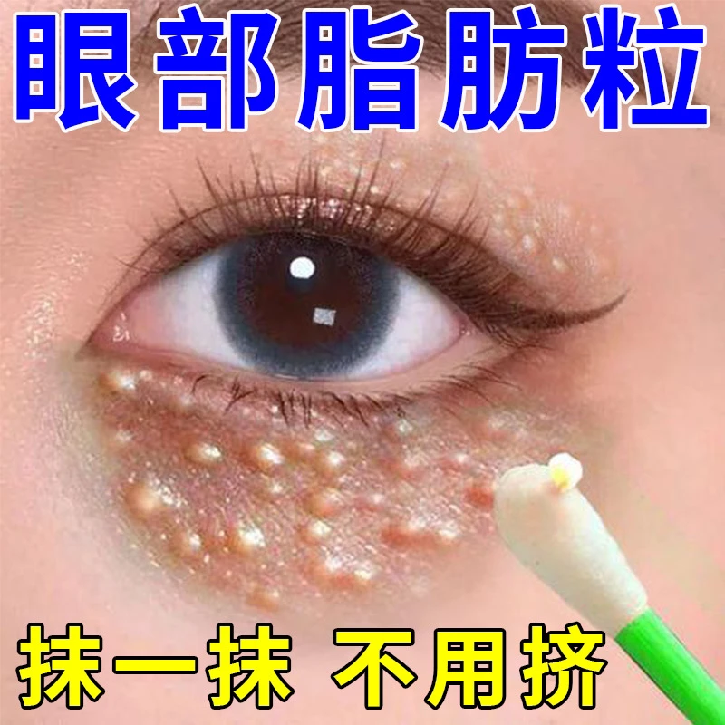 眼部脂肪颗粒祛除汗管颗粒眼周小颗粒淡化油脂粒汗管黄色专用品质