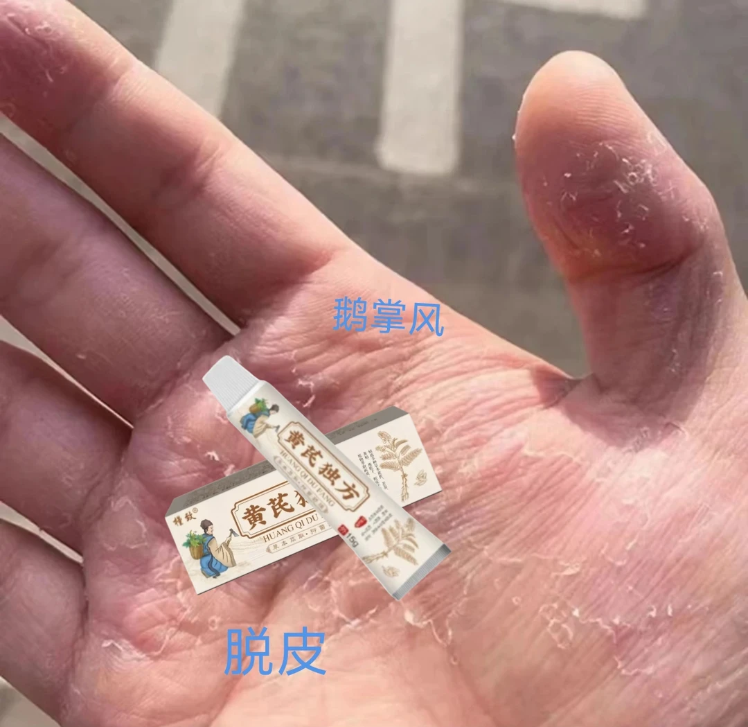 手足脱皮痒起小水包红点起疙瘩手上起皮干燥抑菌舒缓止痒膏