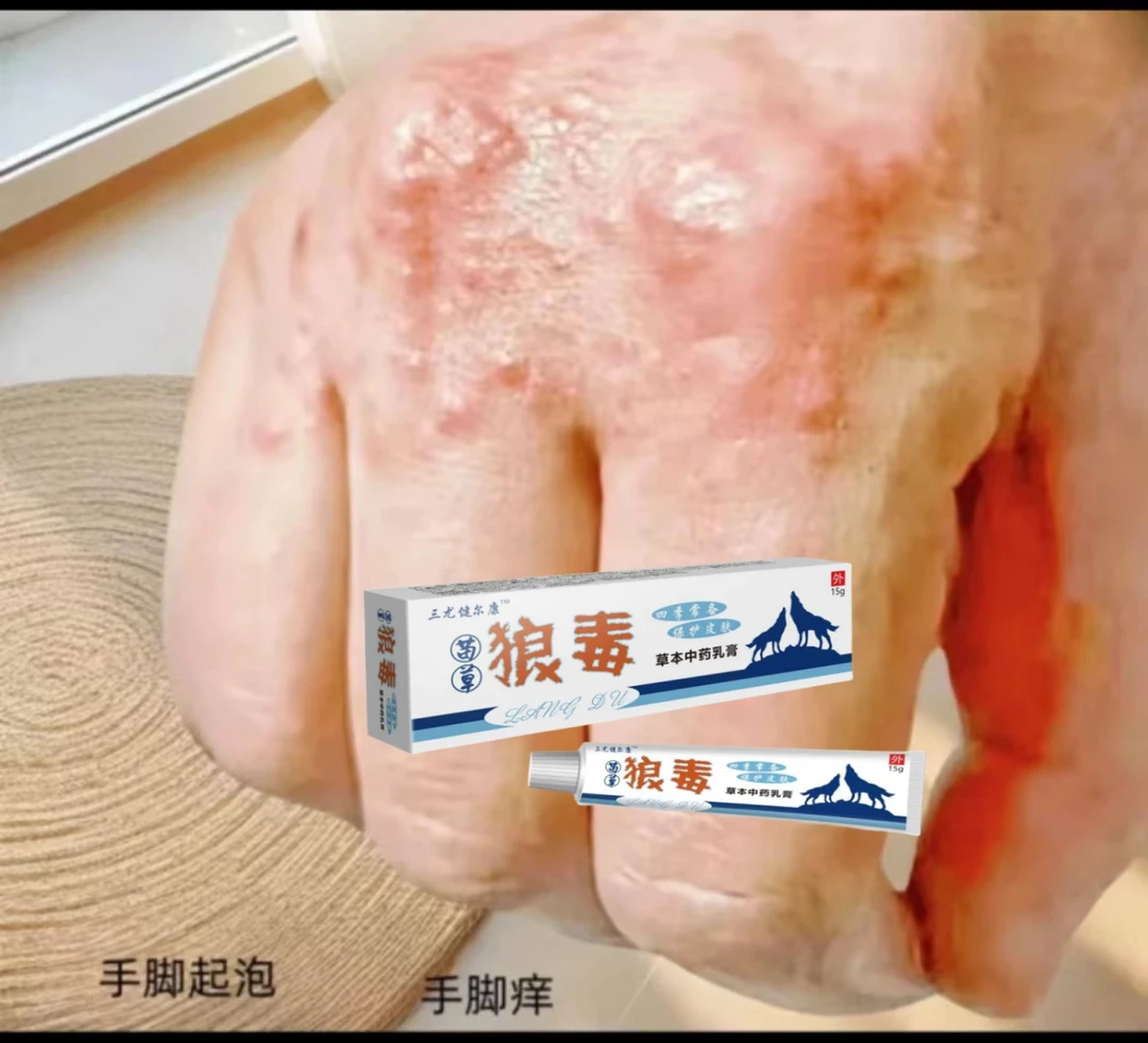 手上起小水·泡汗状水·泡痒手指脱皮专用手足脱皮抑菌膏