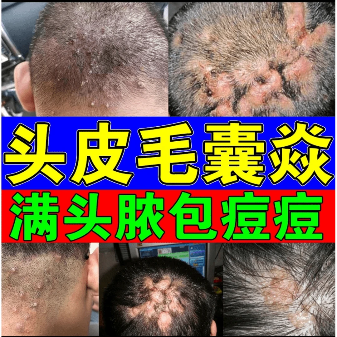 头上有疙瘩痘痘专用毛i囊堵i塞头皮发痒红肿坑坑洼洼毛囊净膏通用