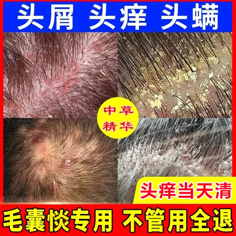 毛炎宁毛囊专用洗发水煤焦油洗剂头皮头部长红疙瘩痘痘去屑止痒