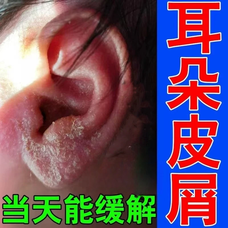 外耳道皮屑耳朵干燥起皮发痒耳朵痒0激素儿童成人专用抑菌止痒膏