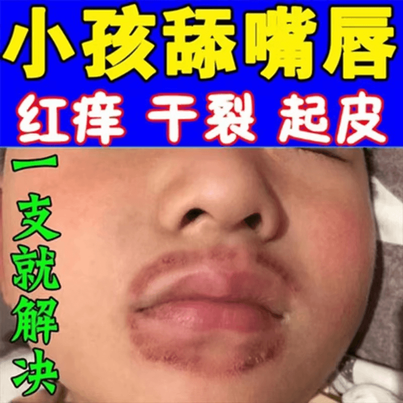 儿童唇干专用小孩舔嘴唇嘴巴周围红痒发黑干裂0激素抑菌止痒软膏