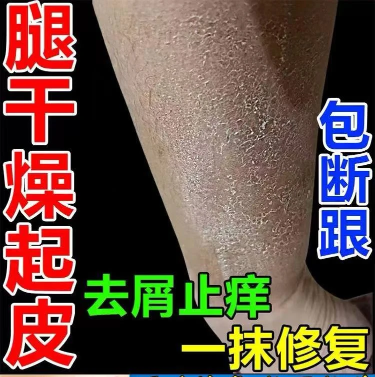腿痒小腿皮肤干燥止痒抑菌软膏夏天腿上起皮身上鱼鳞皮掉屑抑菌膏
