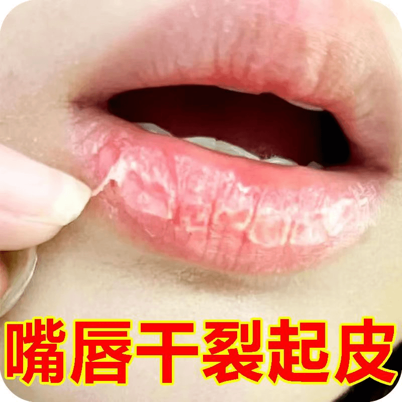 嘴巴干裂起皮掉皮软膏干裂起皮嘴角干裂补水保湿秋冬季防裂润唇