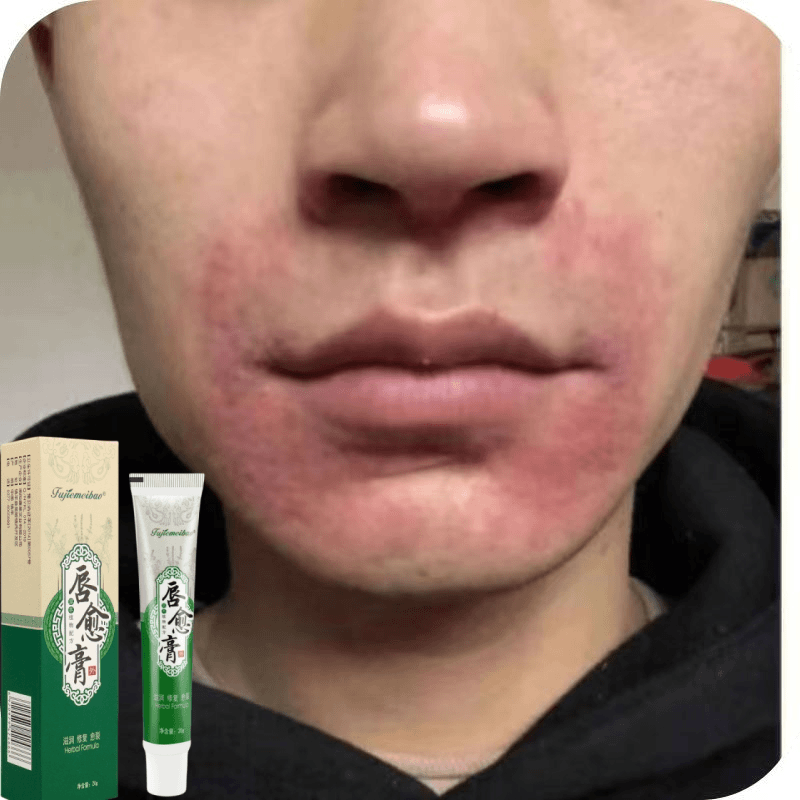 下巴红嘴巴周围红痒口周红一圈脂溢性面部下巴红干起皮脱皮软膏