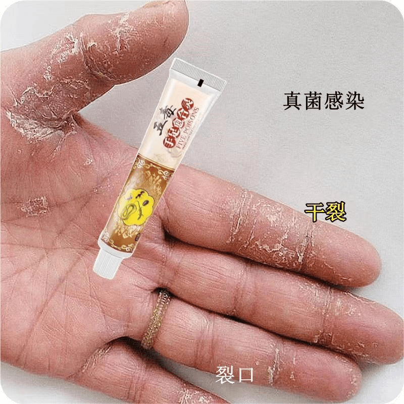 真菌感染手掌裂口干燥起皮干皮手干裂脱皮痒鹅掌风汗小水泡愈合灵