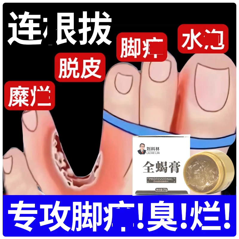 脚痒止痒膏脱皮起水炮干裂开裂脚趾缝痒出汗抑菌止痒神器