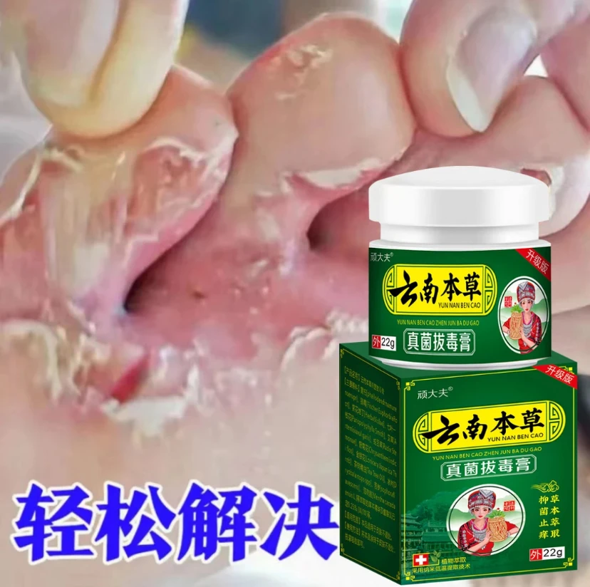 止痒膏去脚出汗脱皮起水炮干裂脚趾缝痒抑菌止痒神器