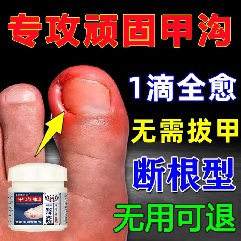 甲沟专用炎指甲往肉里长甲沟宁肌肤液脚趾甲手指甲男女甲沟液