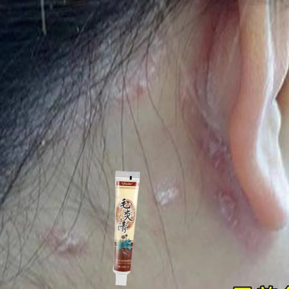 耳根痒头皮毛囊痘痘后脑勺疙瘩痘痘头上掉白皮大块头屑毛炎清软膏