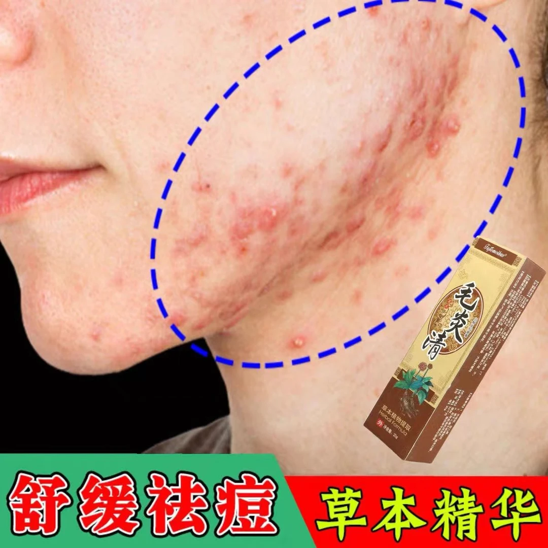 脸上长痘痘淋巴痘腮边痘下巴长痘痘毛囊堵塞硬块专用膏外用膏