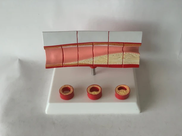 人体血管硬化随年龄血栓形成过程血管病理血管病变人体血管教具