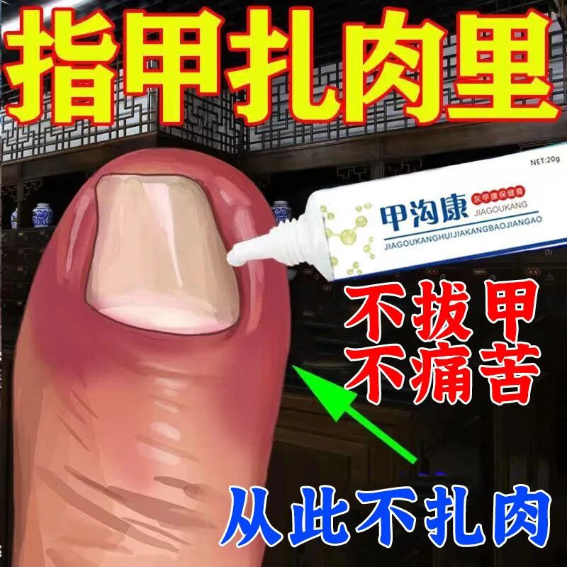 【指甲长肉里】甲沟红的肿大有脓包顶着脚指头疼甲沟康膏肉芽消肿