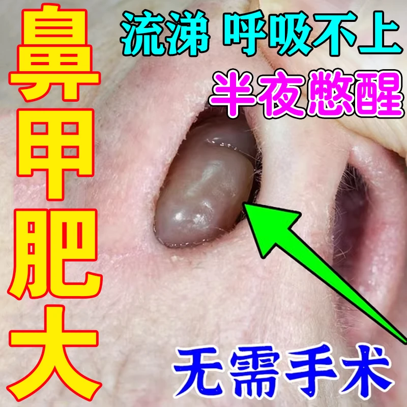 鼻甲肥大的克星鼻塞鼻痒打喷嚏鼻涕粘稠季节性鼻窦专用苍耳 子油
