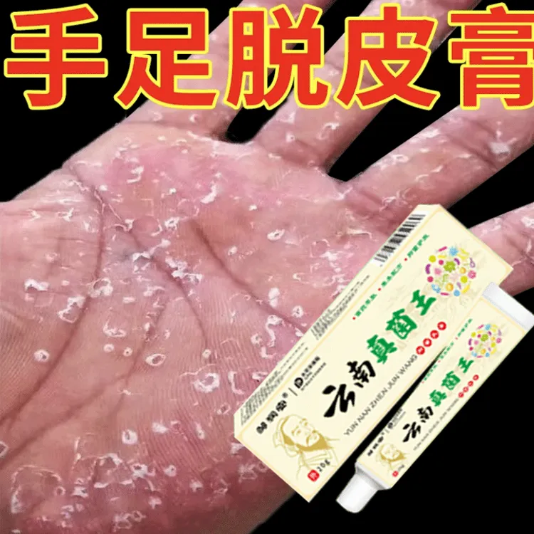 手脚痒皮肤痒手足脱皮膏有效止痒皮肤干燥红痒外用全身干痒止痒膏