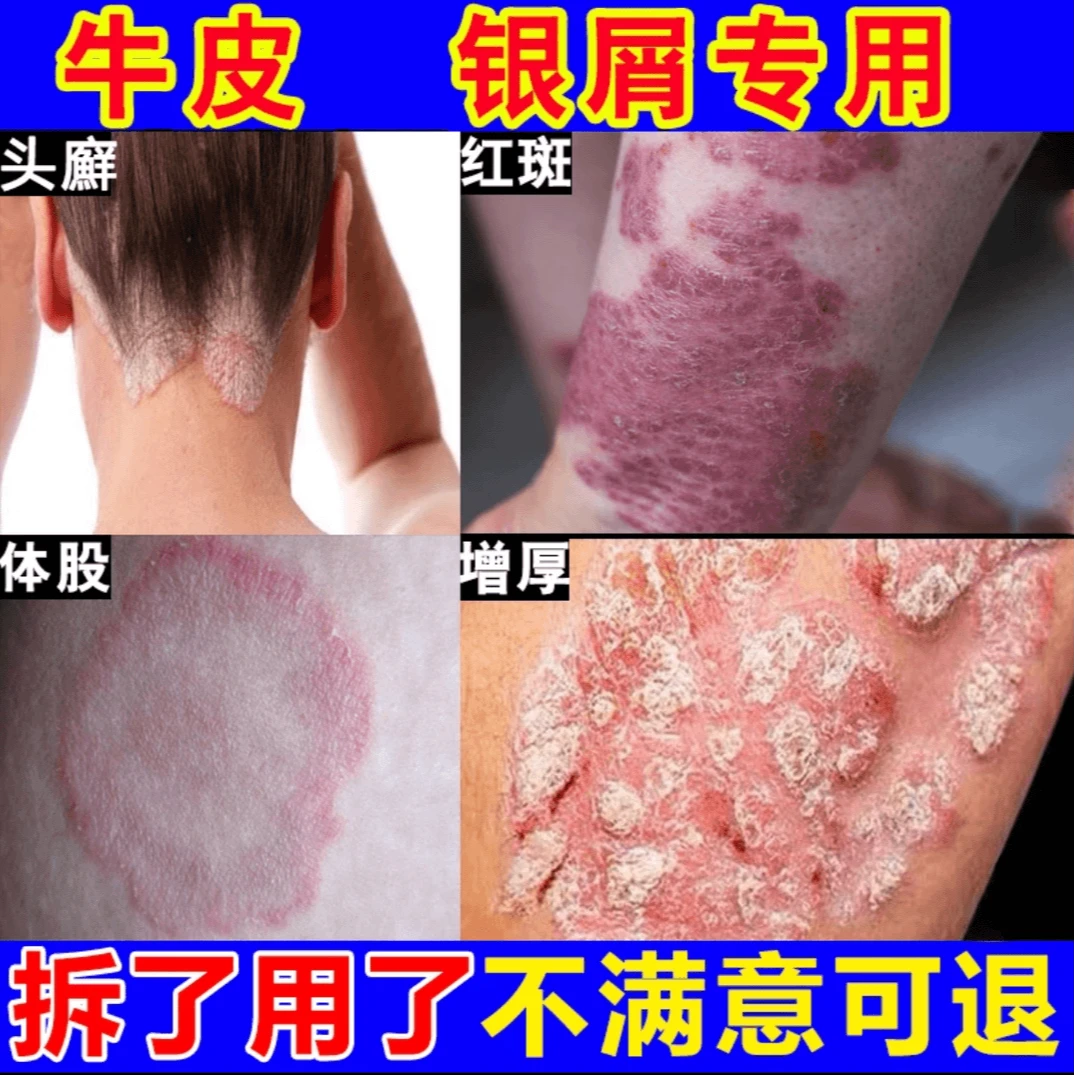 草本神经性皮肤止痒膏顽固皮手足湿痒抑菌乳膏特效修复温和家用