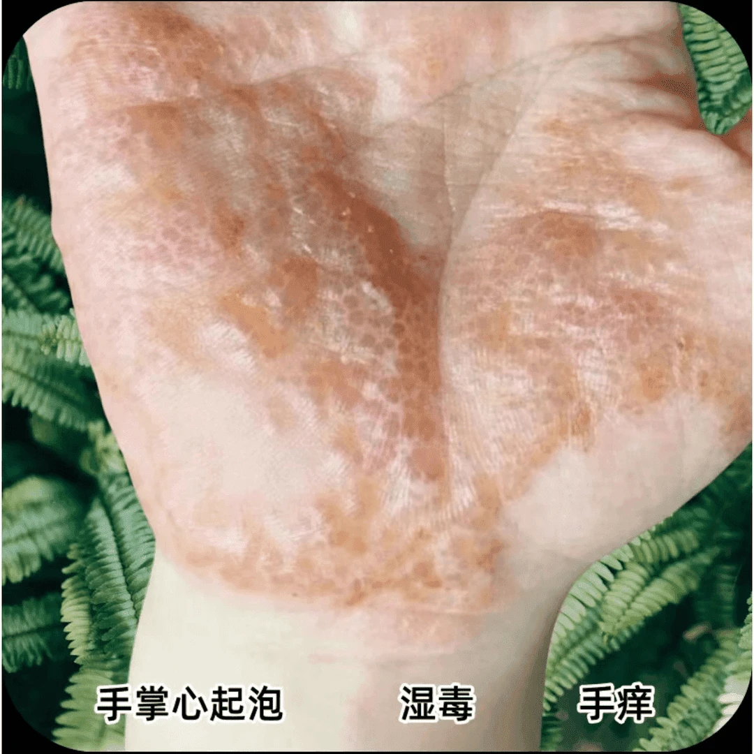 手掌心起泡湿发痒季节性皮痒抑菌修护膏手脚泡痒湿毒百草膏