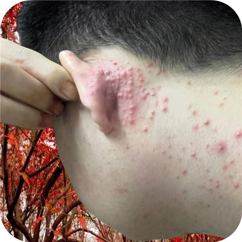 耳朵长疙瘩耳后下巴脖子长痘痘耳朵长痘痘毛囊止痒抑菌软膏