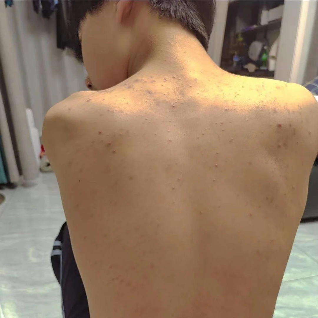 后背大面积毛囊红肿舒缓毛囊螨虫肩部胸部毛囊痘痘专用抑菌软膏