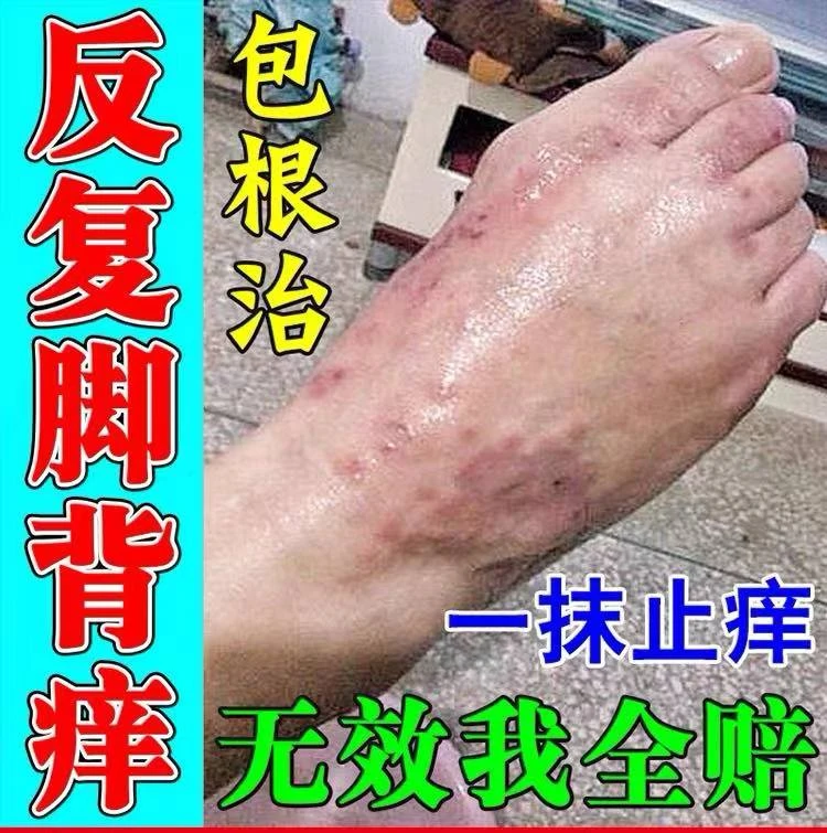 反复脚面痒脚背痒脚面上起红疙瘩水泡小红点红斑晚上脚背干痒软膏